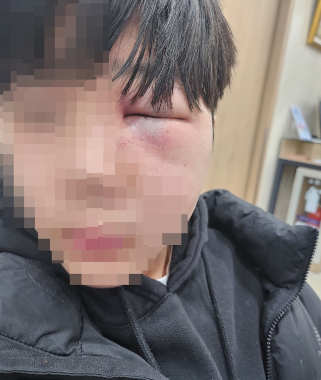폭행으로 망막이 훼손된 학생 얼굴
[독자 제공. 재판매 및 DB 금지]