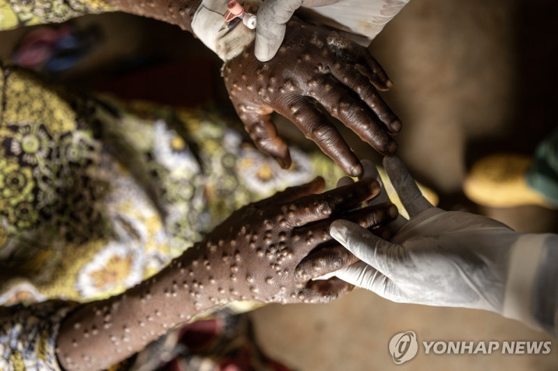 中서 변종 <b>엠폭스</b> <b>집단감염</b>…"민주콩고 다녀온 외국인과 접촉"