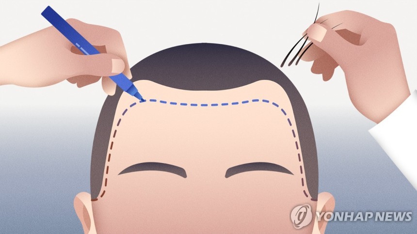 남성 모발이식 (PG)
[강민지 제작] 일러스트