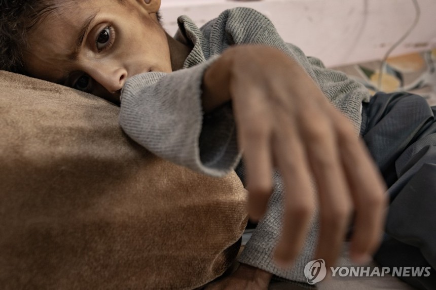 지난달 26일(현지시간) 영양실조로 가자지구 남부 칸 유니스의 나세르 병원에서 치료받는 5세 아동
[EPA 연합뉴스 자료사진. 재판매 및 DB 금지]