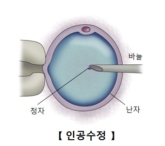 체외 수정
[서울아산병원 제공]