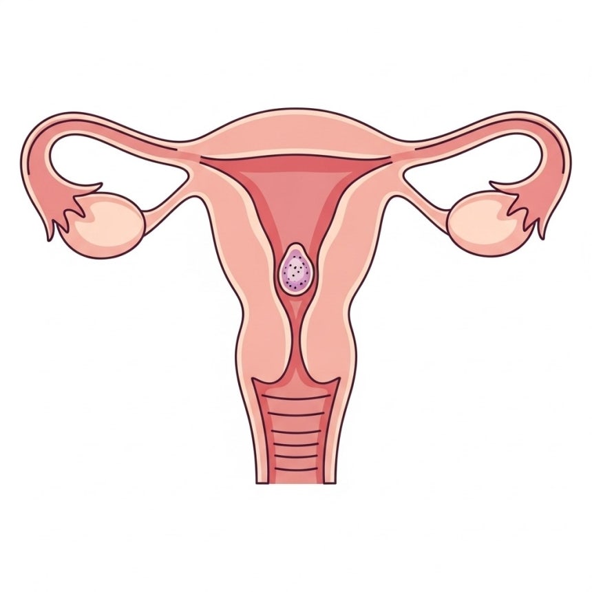 자궁내막암 [자료 이미지]