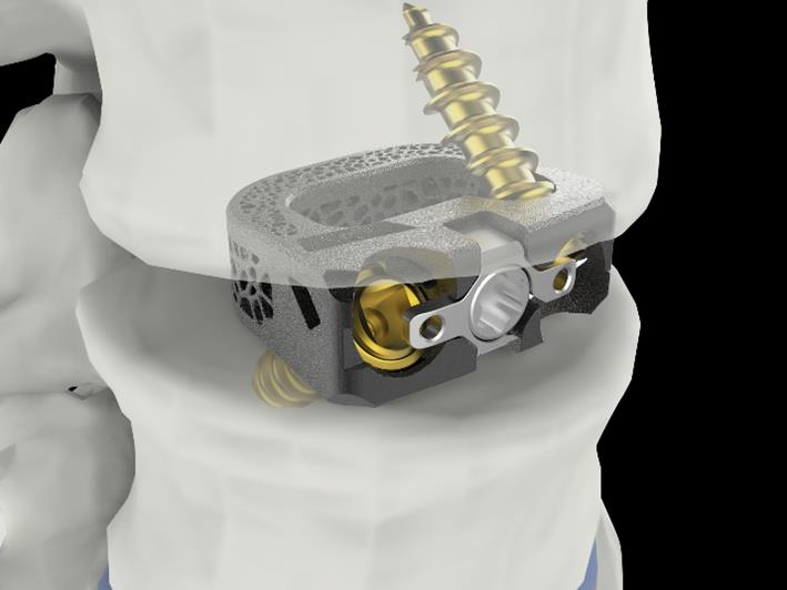 척추 융합기기 '유니스페이스(UniSpace® TPLIF Cage, 요추 케이지)' 
[시지메드텍 제공]