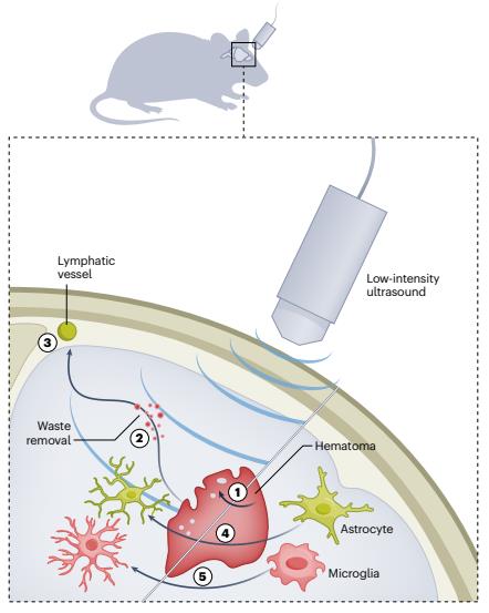 저강도 초음파를 이용한 출혈성 뇌졸중 쥐의 뇌 노폐물 제거 메커니즘 &lt;br/&gt;두가지 형태의 뇌출혈(지주막하 출혈-뇌내/뇌실질 출혈)로 뇌졸중을 유도한 생쥐 모델의 뇌에 주파수 1㎒의 저강도 초점 초음파(LIFU)를 하루 20