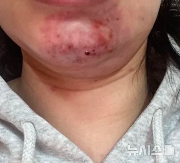 [서울=뉴시스] 상황이 점점 악화되자 마리엄은 다른 병원을 찾아갔고,그곳에서 필러가 혈관을 막아 발생한 '혈관 폐색'이라는 진단을 받았다.(사진=데일리메일)