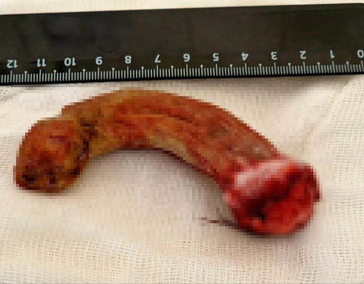 [서울=뉴시스]각질종.(사진=영국 매체 '데일리 미러' 캡처) *재판매 및 DB 금지