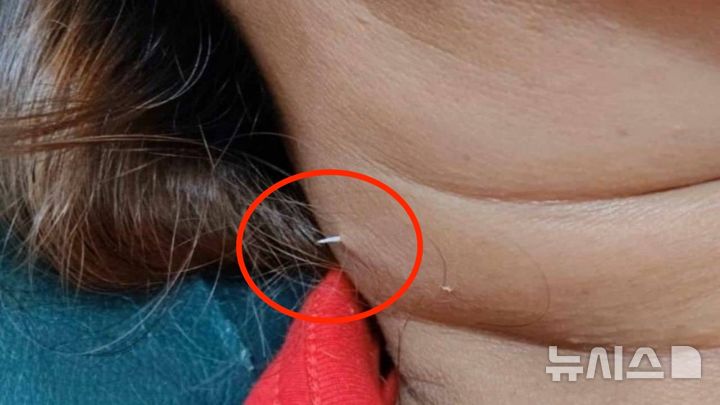 [뉴시스] 태국에서 40대 여성이 식사 중에 삼킨 생선가시가 목을 관통해 피부 밖으로 돌출됐다. (사진=페이스북)