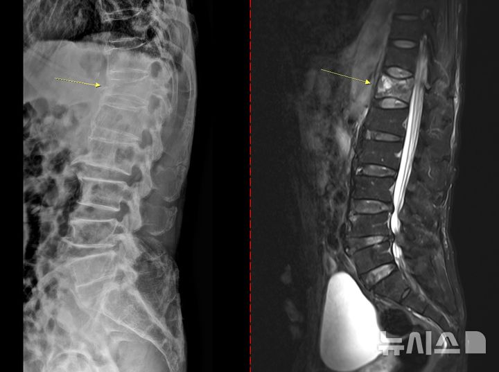 [서울=뉴시스] 골다공증성 압박골절 환자의 척추 엑스레이(왼쪽) 와 MRI(오른쪽).(사진= 고려대안산병원 제공)