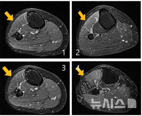 [서울=뉴시스] 근육 손상이 진행되는 과정을 단계별로 보여주는 MRI 사진.(사진= 한림대춘천성심병원 제공)