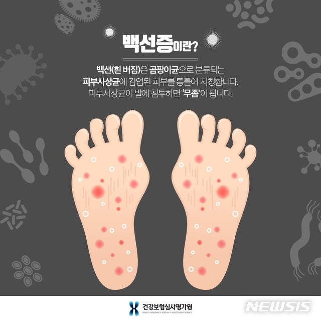 장마철에 발 꼼지락대다 온 가족 간지러워 미칠 수 있다