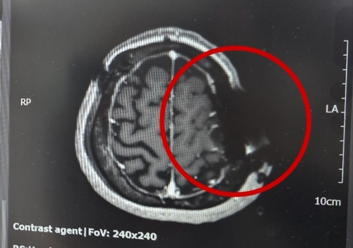 머리뼈에 쇠톱 날이 박혀 동그라미 부분이 자기공명영상(MRI)이 제대로 찍히지 않은 모습. 연합뉴스