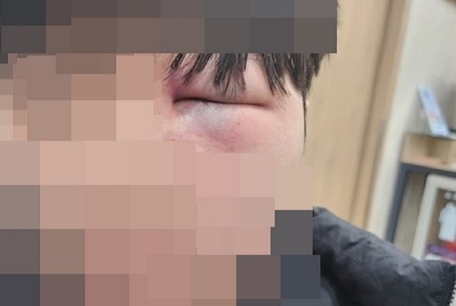 충남 아산의 한 중학교에서 발생한 학폭 사건의 피해 학생 얼굴. 연합뉴스