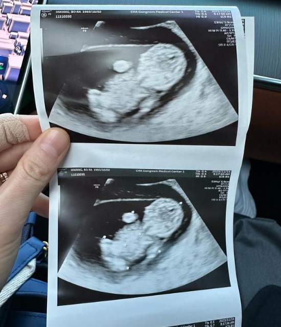 황보라의 아기 초음파 사진. 황보라 인스타그램 캡처