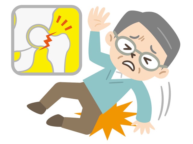 한번 골절 땐 재발률 5배인데… ‘골형성치료제’ 제때 못쓴다?