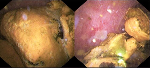 담관에 생긴 거대 결석(왼쪽)과 레이저로 부서진 결석.순천향대부천병원
