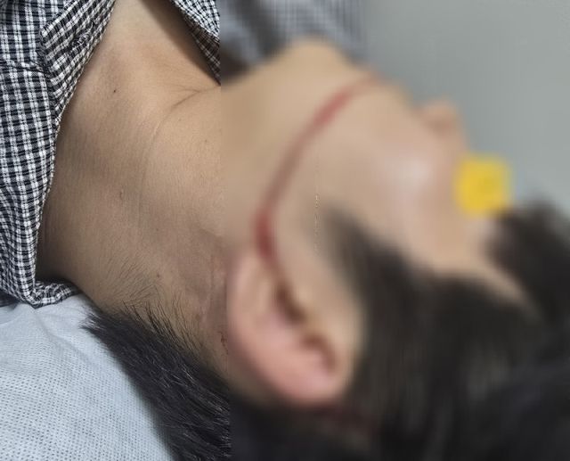 고압워터건에 부상을 입은 피해자 A씨의 모습.연합뉴스