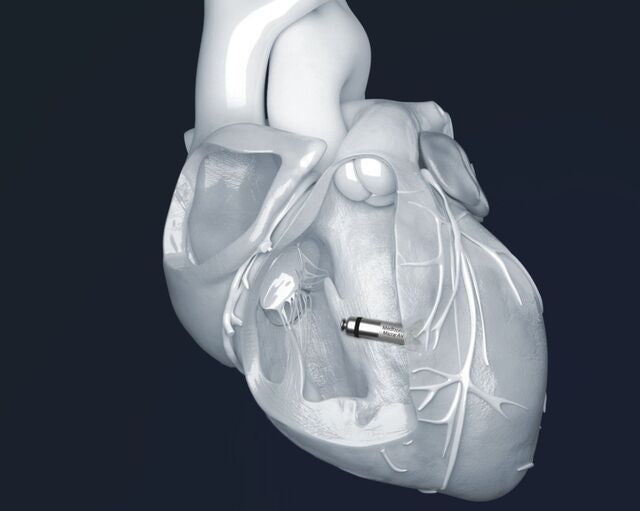 심장 느리게 뛰는 서맥성 부정맥 치료… ‘무전극선 심박동기’ 뜬다