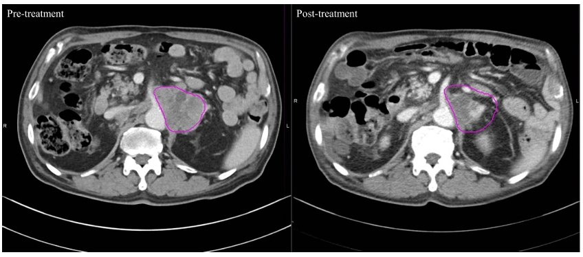 고주파 온열치료 전(왼쪽)보다 치료 후(오른쪽)암 병변 부위가 줄어든 사진. /사진=장홍석 교수 연구팀 논문 발췌