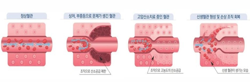 고압산소치료의 단계별 치료 원리를 설명한 그림. /자료=한림대한강성심병원