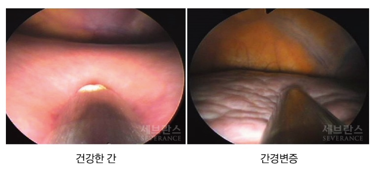 고환 작아지고 거미 혈관 보이면 간경변 위험이라던데?