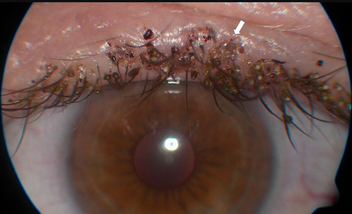 눈에 극심한 가려움을 느끼던 50대 남성의 속눈썹과 눈꺼풀에서 기생충이 발견된 사례가 보고됐다./사진= 피부과 온라인 저널