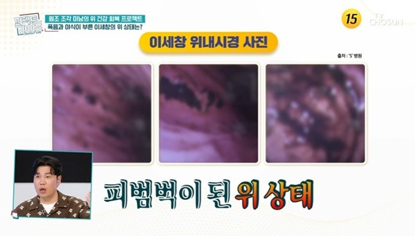 이세창, '피범벅' 위내시경 사진 공개…"소주 10병→2병 줄여"