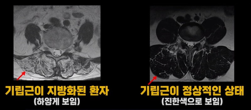 70대이후 심하게 구부러진 허리…협착증 아닐수도