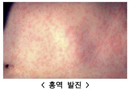  홍역 발진.[사진 = 질병관리청]