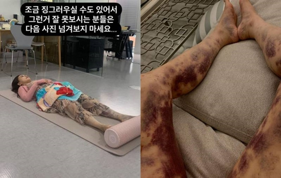 ‘전신 <b>피멍</b>’ <b>아옳이</b>, 13억 <b>소송</b> 4년만 <b>승소</b>