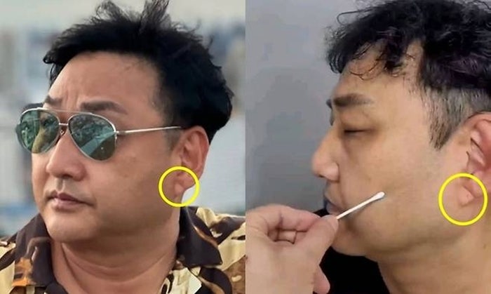 “<b>김수용 귓불주름</b>은 <b>노화</b>”…흉부외과 교수가 밝힌 심근경색 진짜 전조...