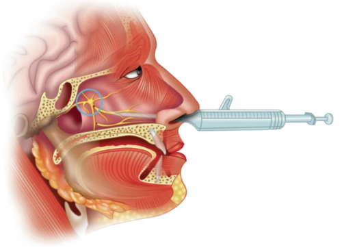  파란색 원으로 표시하고 있는 부분이 스페노팔라틴 신경절이다.스페노팔라틴 신경절 차단술을 설명하기 위한 삽화를 빌려왔다.한 뼘짜리 주사가 얼굴을 관통하고 있는데 세상 따분한 얼굴로 평정심을 유지하고 있는 점이 대