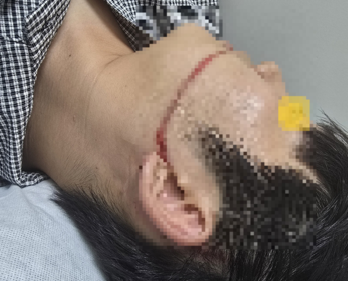 물축제 공연중 워터건에 맞아 얼굴을 다친 피해자의 모습 [피해자]