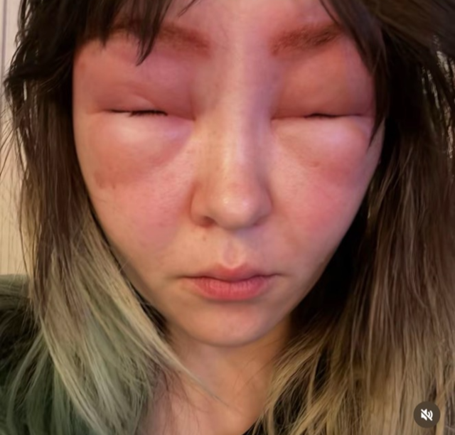 눈썹 염색했다가 얼굴 퉁퉁 부은 여성의 경고! 꼭 패치 테스트 해