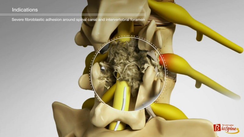 서울 광혜병원, MRI도 못찾는 요통 실체 '척추유착' 추간공확장술로 치료