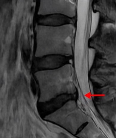 허리디스크와 다른 '디스크내장증' 무리한 운동·장시간 좌식 피하세요