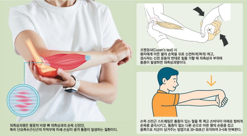 날씨 좋아 야외활동 늘렸을 뿐인데 …'테니스 엘보' 주의보