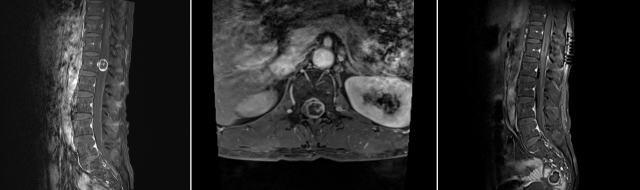 50세 척수종양 환자에게 척추자기공명영상(MRI) 검사를 시행한 결과 측면(왼쪽)과 단면(가운데) 사진에서 제1 요추 부위 척추관 내에 1.6x1.8㎝ 크기의 경막내 수외종양이 관찰된다. 수술 후 측면 사진(오른쪽)
