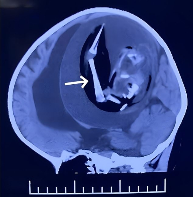 중국의 한 여아 두개골 속에서 발견된 쌍둥이 태아의 모습. /사진=American Journal of Case Reports