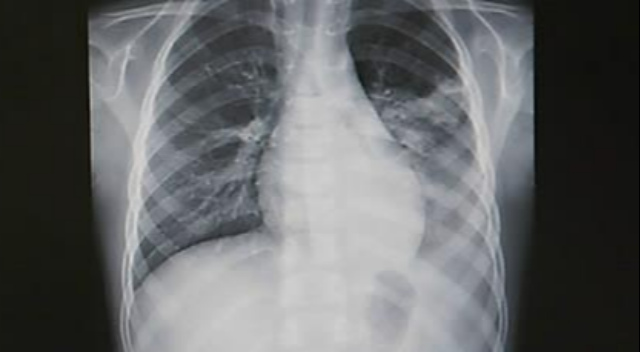 감기인 줄 알았던 16개월 아기 갑자기 사망했대 폐렴 조심해야겠다