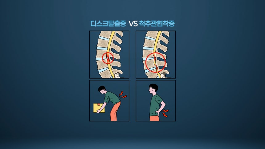 허리디스크와 척추관협착증 / 서울경제TV‘지금 명의’캡처