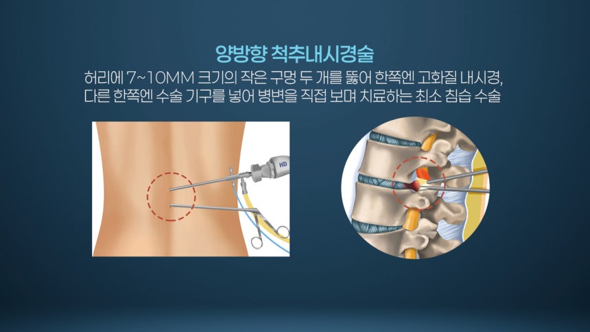 양방향 척추 내시경 수술.최소침습수술의 하나./ 서울경제TV‘지금 명의’캡처