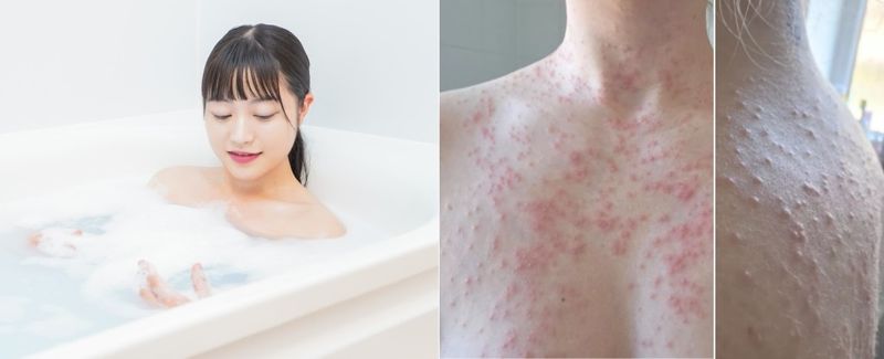 친구들과 함께 여행을 떠난 한 여성이 호텔 온수 욕조 이용 후 전신에 퍼진 발진으로 극심한 고통을 겪은 사연이 전해졌다. 출처=미러, 게티이미지뱅크