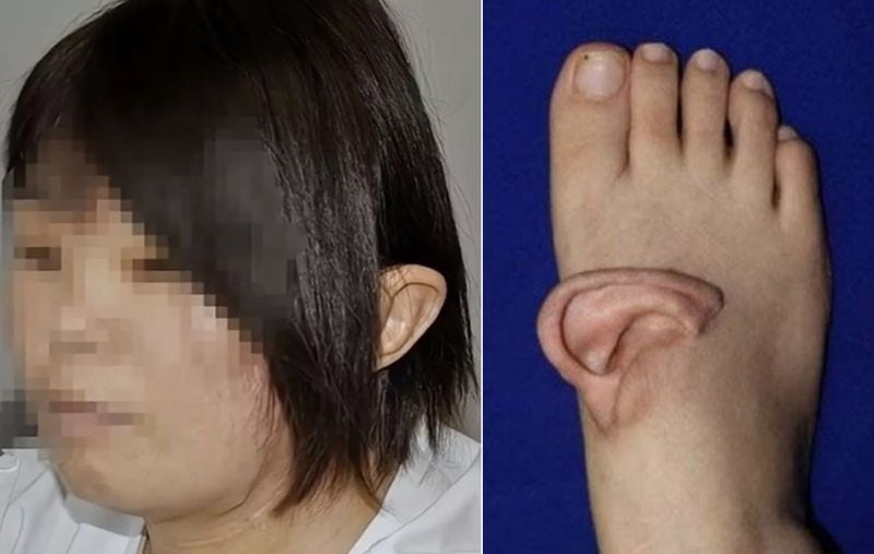 "발등에 귀가 붙었다고?"..5개월 동안 '발등'에 귀 달고 다닌 女, 무슨 일 [헬스톡]