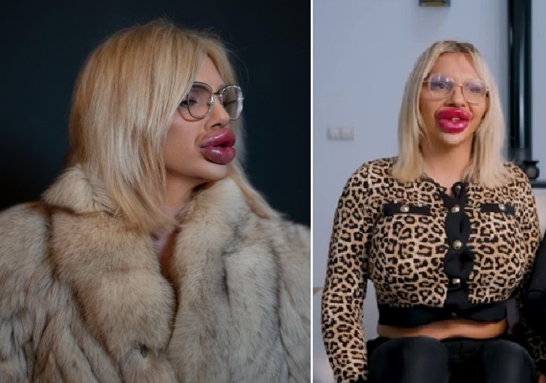 큰 입술을 가진 비엔나 뷔르스텔이 아이가 태어난 뒤 악플 때문에 괴롭다고 호소했다.출처= 더 선