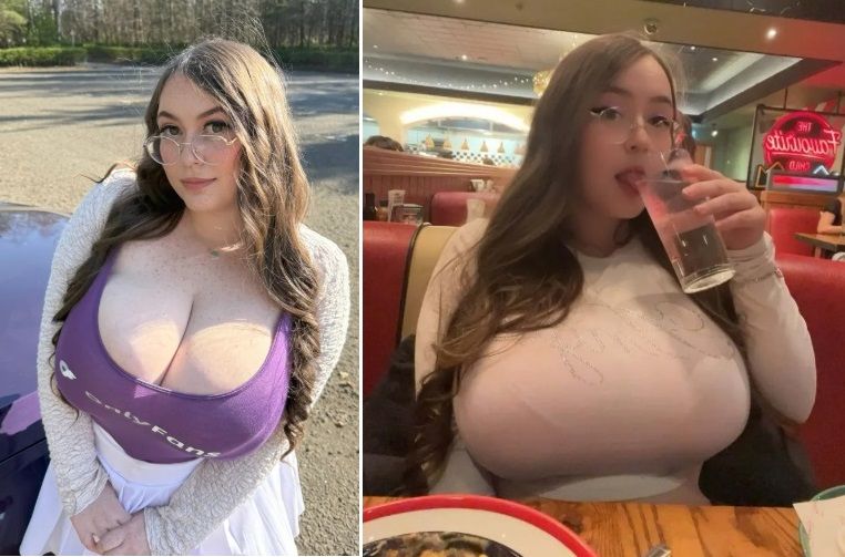 유방이 계속 커지는 거대유방증을 앓는 서머 로버트.출처=더 선