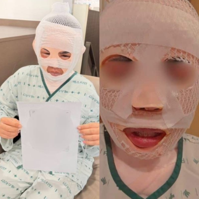 [뉴시스] 태국인 여성이 한국인 남자친구에게 끓는 물을 맞아 얼굴에 심각한 화성을 입었다고 밝혔다.피해 여성은 현재 서울의 한 병원에 입원 중인 것으로 알려졌다.(사진 = 페이스북 갈무리) 2025.12.10.