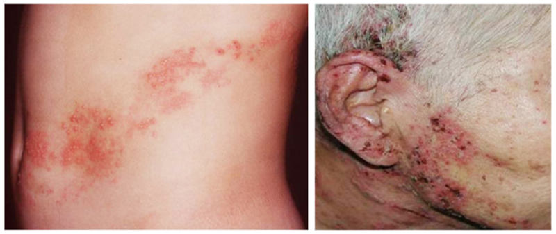 대상포진의 초기 증상은 신체의 한 쪽에서 나타나는 찌릿하거나 화끈거리는 통증이다.보통 통증이 2~3일 정도 지속된 뒤 신경을 따라 띠 모양으로 발진이 나타난다.사진=질병관리청·국민건강관리포털