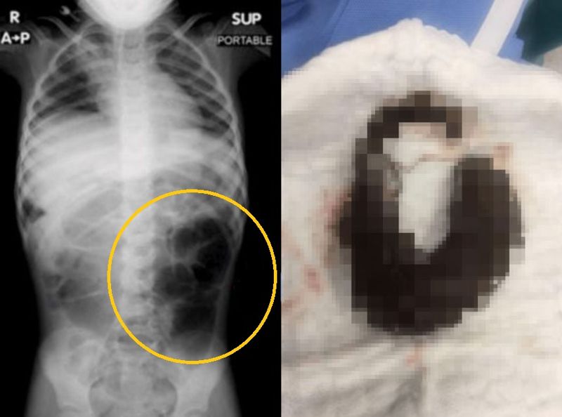 복통을 호소하던 6세 여아의 뱃속에서 머리카락 덩어리가 발견됐다.사진=큐레우스저널