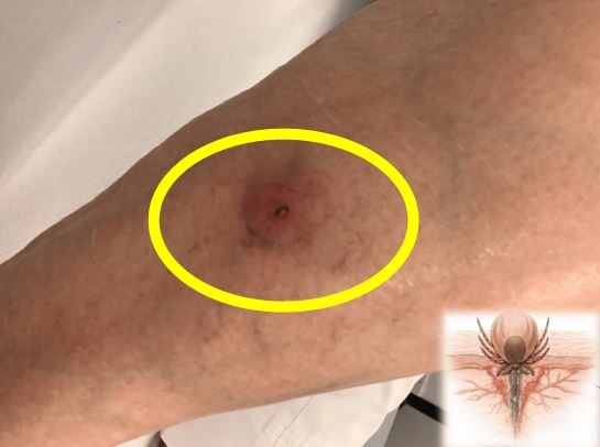 피부 가려움증을 호소하던 80대 여성의 몸에서 진드기가 발견된 사례가 보고됐다./사진=큐레우스