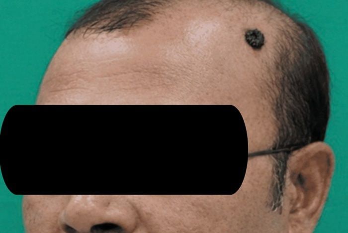 20년 된 점인 줄 알았는데…알고 보니 두피서 자란 '암' [헬스톡]